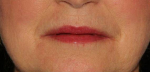 Filler & Botox to lip lines After